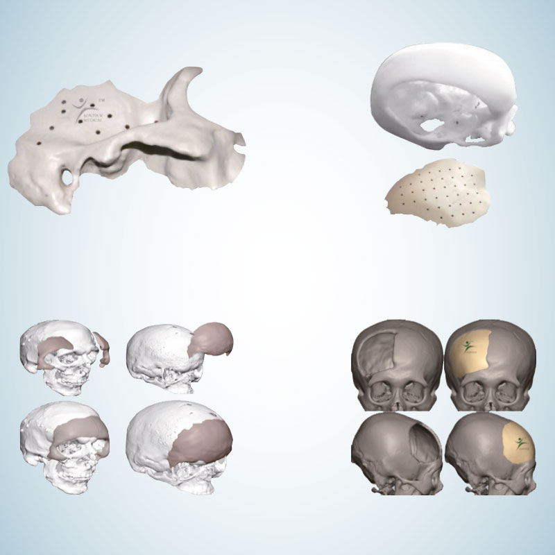 Protesi 3D - Gallery
