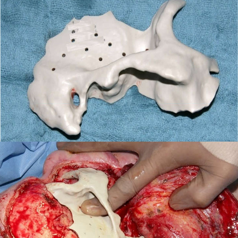 3D Prostheses - Clinical cases