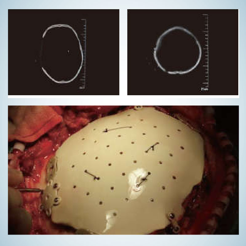 3D Prostheses - Clinical cases