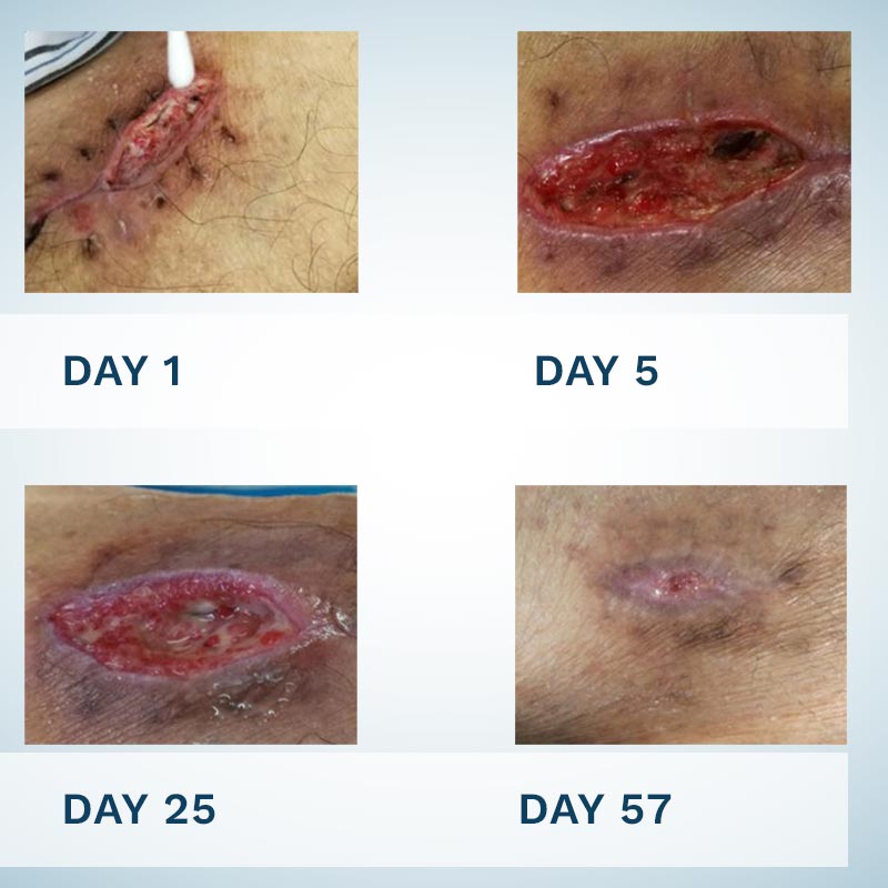 WOUND CARE - PULSAR - Gallery